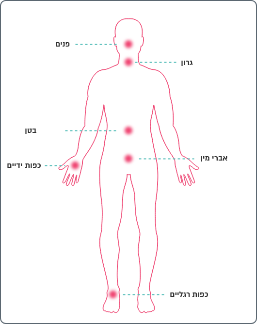 אזורים בגוף בהם התקפי נפיחות יכולים להופיע